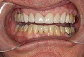 Dental Implants Dentist Greensboro