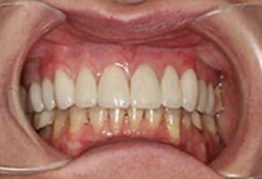 Dental Implants Dentist Greensboro