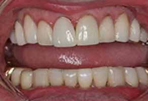 Dental Implants Dentist Greensboro