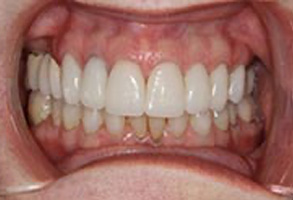 Dental Implants Dentist Greensboro