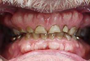 Dental Implants Dentist Greensboro